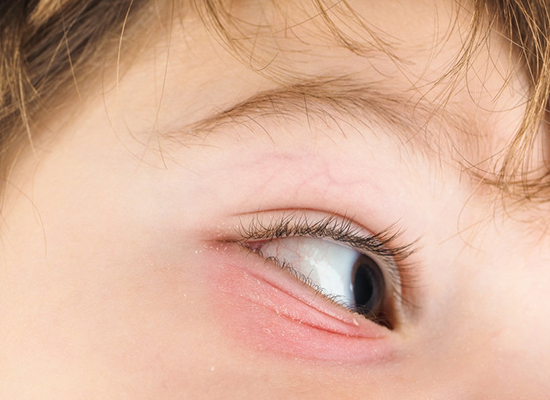 Pink Eye and When To See a Doctor